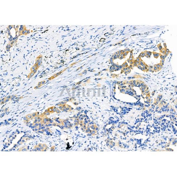 MMP11 Antibody - AF0211 at 1/100 staining Human lung cancer by IHC-P.