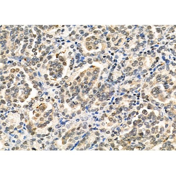 LMX1B Antibody - AF0341 at 1/100 staining Human kidney cancer by IHC-P.