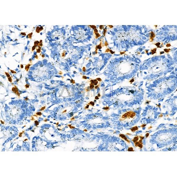 Sin3B Antibody - AF9199 at 1/100 staining Human gastric cancer by IHC-P.