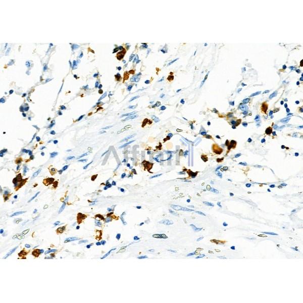 Sin3B Antibody - AF9199 at 1/100 staining Human prostate cancer by IHC-P.