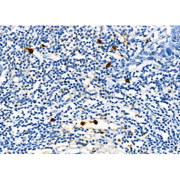 Sin3B Antibody - AF9199 at 1/100 staining Human pancreatic cancer by IHC-P.