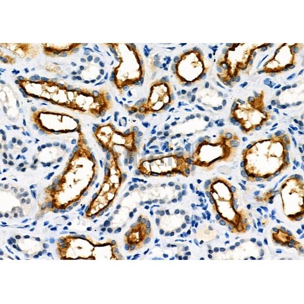 USP36 Antibody - AF9223 at 1/100 staining Human kidney cancer and adjacent normal tissues by IHC-P.