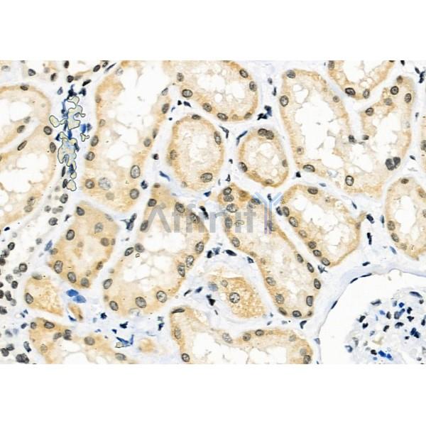 PCTK2 Antibody - DF10139 at 1/100 staining Human kidney cancer and adjacent normal tissues by IHC-P.