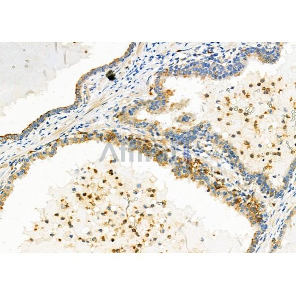 TRIO Antibody - DF2685 at 1/100 staining Human prostate cancer by IHC-P.