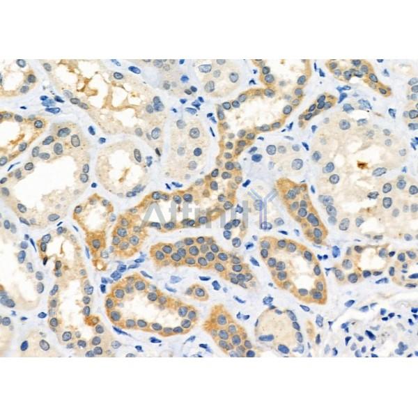 GPR80/GPR99 Antibody - DF2765 at 1/100 staining Human kidney cancer and adjacent normal tissues by IHC-P.