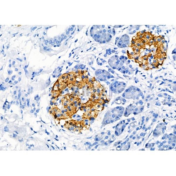 GPR141 Antibody - DF2797 at 1/100 staining Human pancreatic cancer and adjacent nomal tissues by IHC-P.