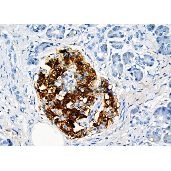 GPR162 Antibody - DF2799 at 1/100 staining Human pancreatic cancer and adjacent nomal tissues by IHC-P.