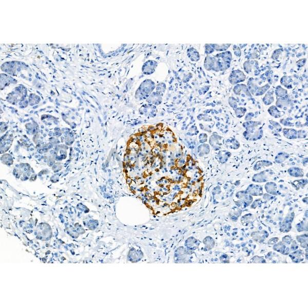 GPR33 Antibody - DF2804 at 1/100 staining Human pancreatic cancer and adjacent nomal tissues by IHC-P.