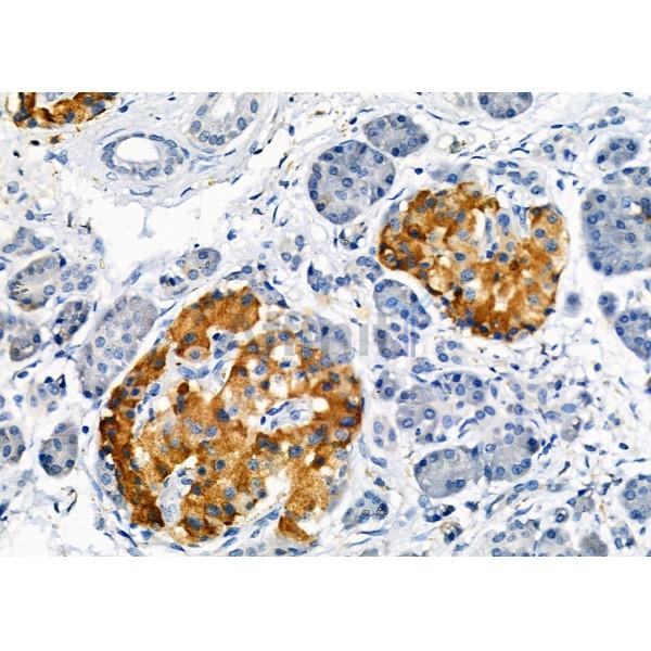 OR5AN1 Antibody - DF2830 at 1/100 staining Human pancreatic cancer and adjacent nomal tissues by IHC-P.