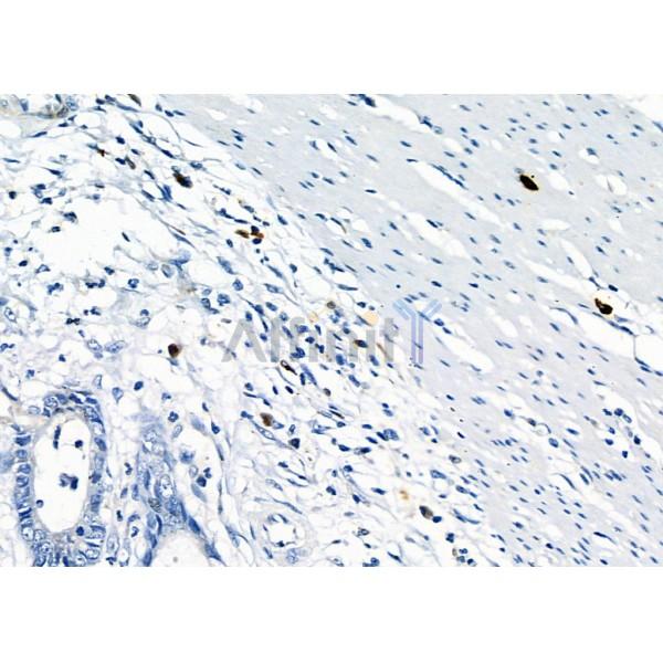 RAB38 Antibody - DF4404 at 1/100 staining Human gastric cancer by IHC-P.