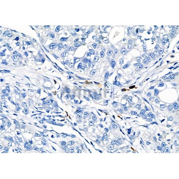 RAB38 Antibody - DF4404 at 1/100 staining Human gastric cancer by IHC-P.