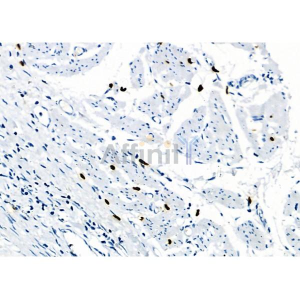 RAB38 Antibody - DF4404 at 1/100 staining Human esophageal cancer by IHC-P.