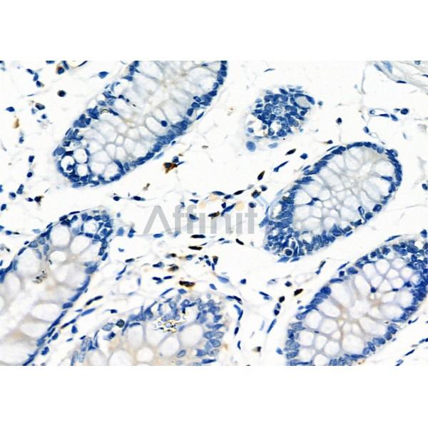 RAB38 Antibody - DF4404 at 1/100 staining Human colorectal cancer and adjacent normal tissues by IHC-P.