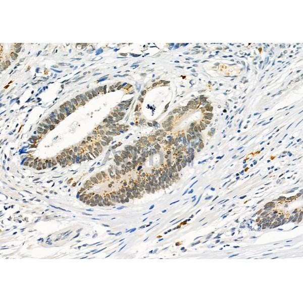 RALY Antibody - DF4657 at 1/100 staining Human colorectal cancer and adjacent normal tissues by IHC-P.