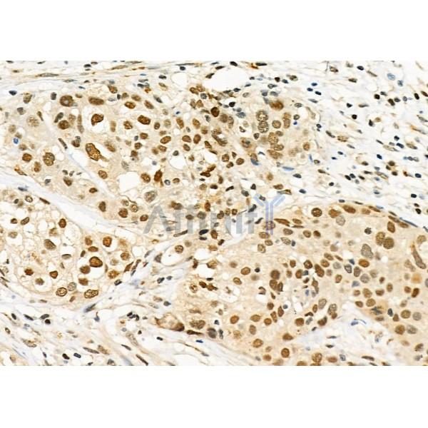 RALY Antibody - DF4657 at 1/100 staining Human ovarian cancer by IHC-P.
