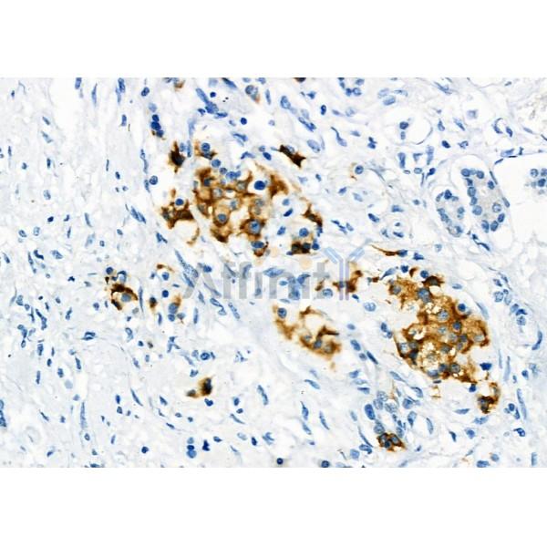 GSS Antibody - DF6214 at 1/100 staining Human pancreatic cancer by IHC-P.