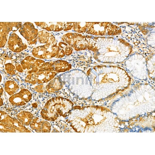PGC Antibody - DF7081 at 1/100 staining Human gastric cancer and adjacent normal tissues by IHC-P.