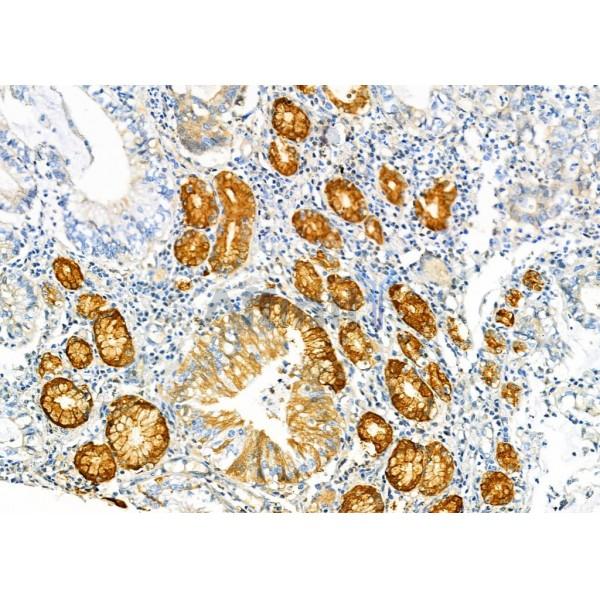 PGC Antibody - DF7081 at 1/100 staining Human gastric cancer by IHC-P.