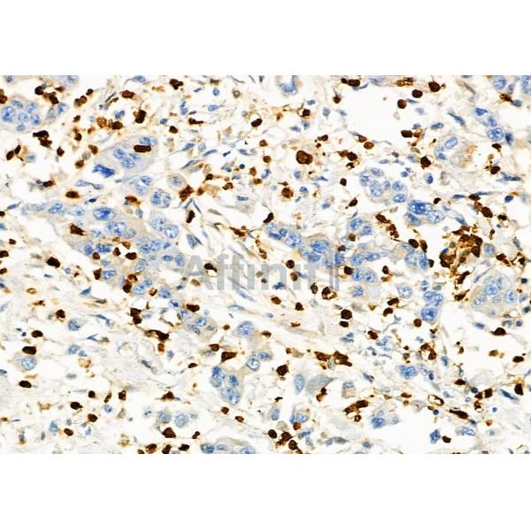 SSTR2 Antibody - DF7206 at 1/100 staining Human gastric cancer by IHC-P.