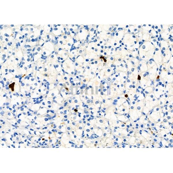 SSTR2 Antibody - DF7206 at 1/100 staining Human kidney cancer by IHC-P.