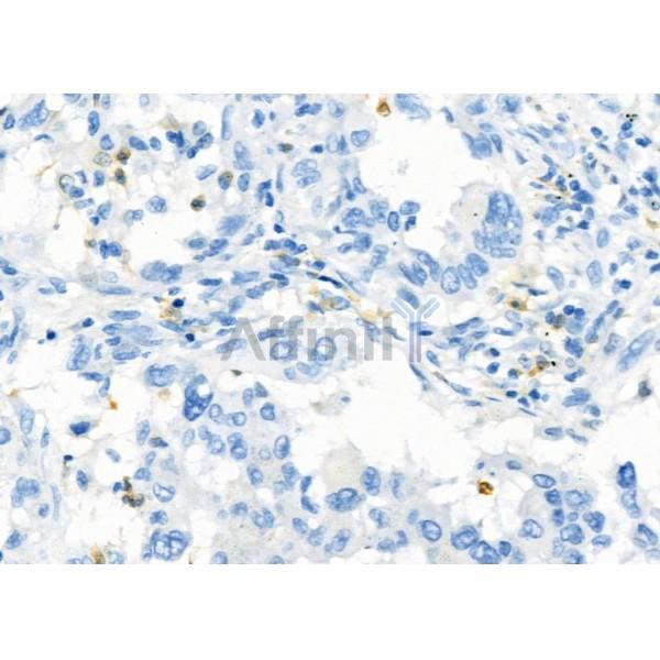 SSTR2 Antibody - DF7206 at 1/100 staining Human lung cancer by IHC-P.