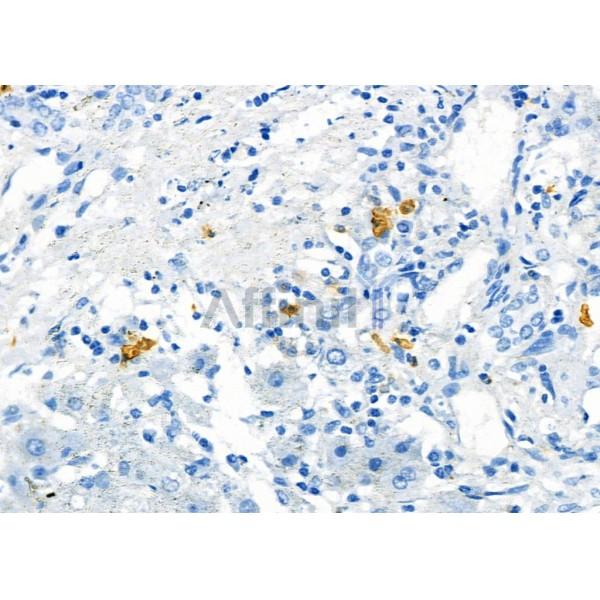 SSTR2 Antibody - DF7206 at 1/100 staining Human liver cancer and adjacent normal tissues by IHC-P.