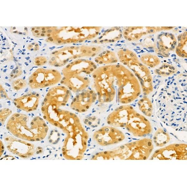 PIWIL4 Antibody - DF7207 at 1/100 staining Human kidney cancer and adjacent normal tissues by IHC-P.