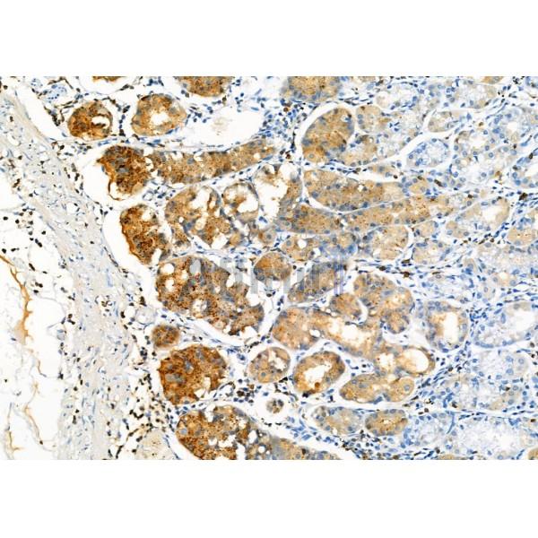 NQO2 Antibody - DF7342 at 1/100 staining Human gastric cancer and adjacent normal tissues by IHC-P.