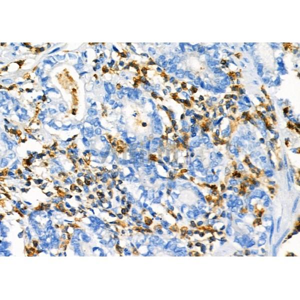 NQO2 Antibody - DF7342 at 1/100 staining Human gastric cancer by IHC-P.