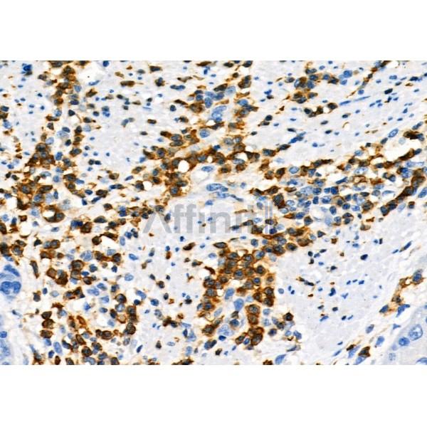 NQO2 Antibody - DF7342 at 1/100 staining Human esophageal cancer by IHC-P.