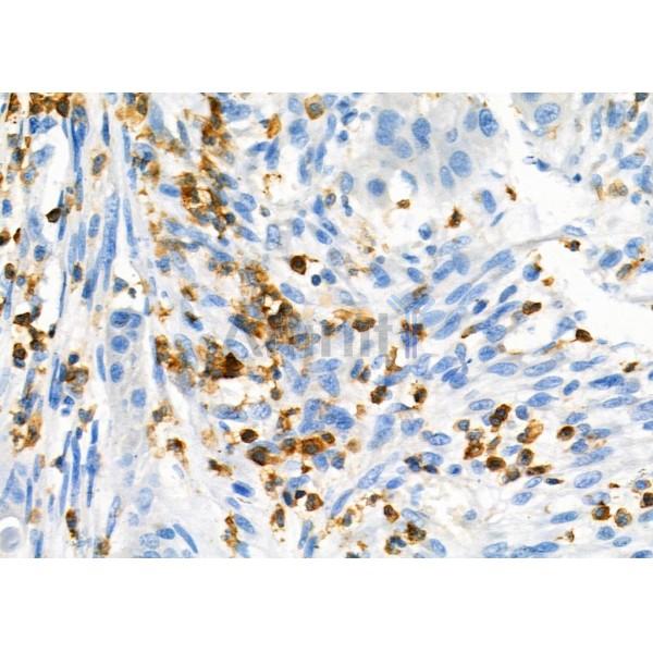NQO2 Antibody - DF7342 at 1/100 staining Human esophageal cancer by IHC-P.