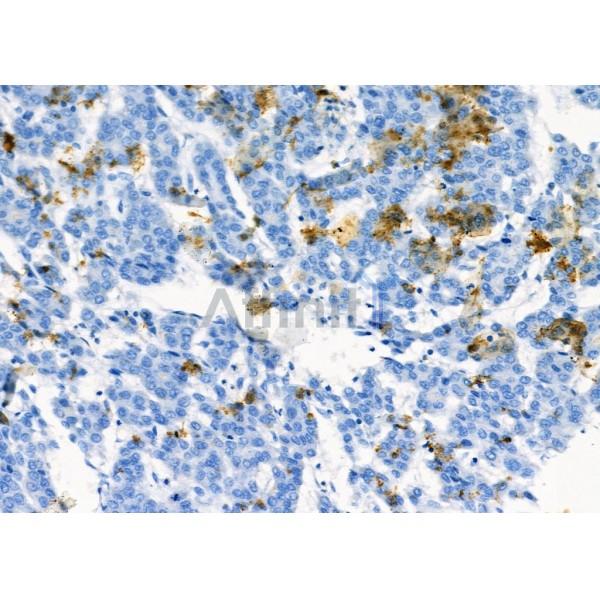 NQO2 Antibody - DF7342 at 1/100 staining Human liver cancer by IHC-P.