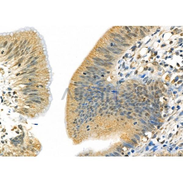 SIGMAR1 Antibody - DF7363 at 1/100 staining Human colorectal cancer by IHC-P.