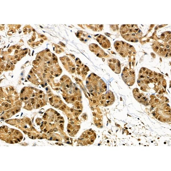 SIGMAR1 Antibody - DF7363 at 1/100 staining Human pancreatic cancer and adjacent nomal tissues by IHC-P.