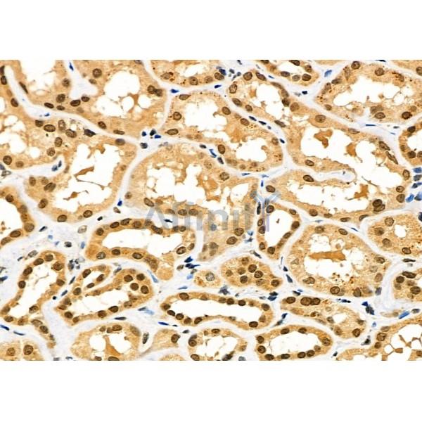 SIGMAR1 Antibody - DF7363 at 1/100 staining Human kidney cancer and adjacent normal tissues by IHC-P.