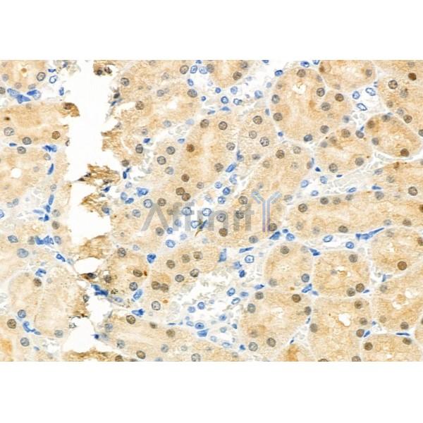 RFC4 Antibody - DF7367 at 1/100 staining Human gastric cancer by IHC-P.