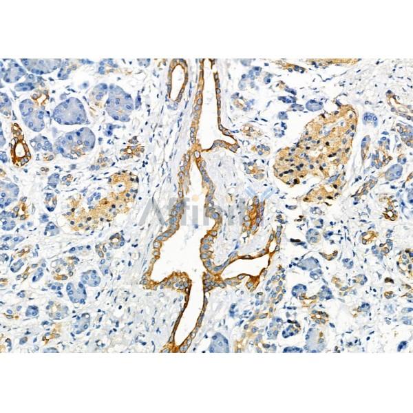 SCARF1 Antibody - DF7922 at 1/100 staining Human pancreatic cancer and adjacent nomal tissues by IHC-P.