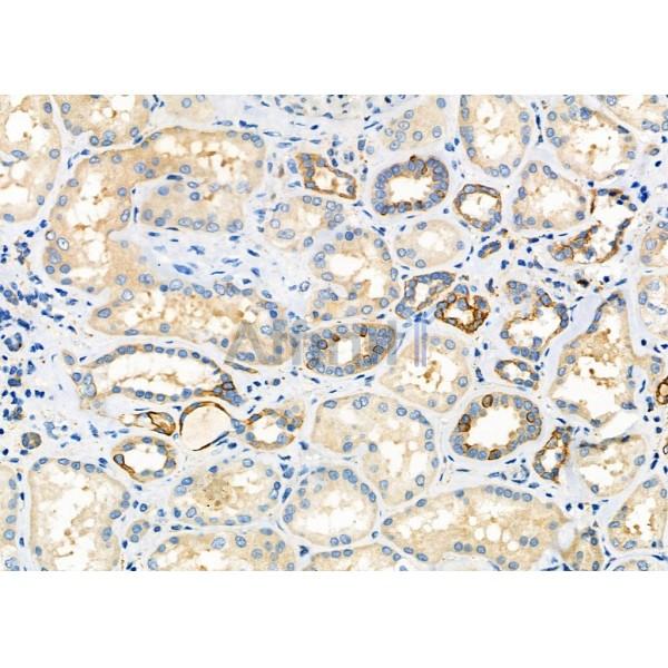 SCARF1 Antibody - DF7922 at 1/100 staining Human kidney cancer and adjacent normal tissues by IHC-P.
