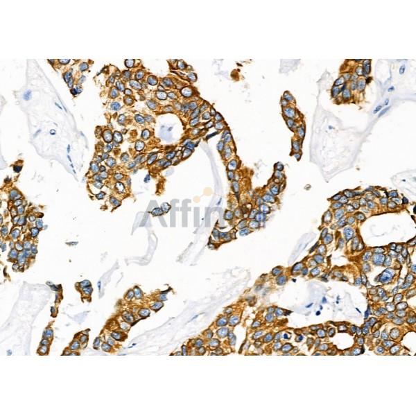 SCARF1 Antibody - DF7922 at 1/100 staining Human mammary cancer by IHC-P.