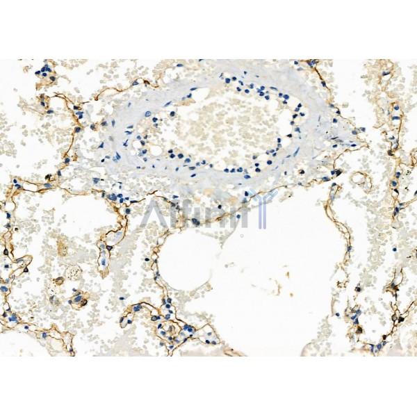 SCARF1 Antibody - DF7922 at 1/100 staining Human lung cancer and adjacent normal tissues by IHC-P.