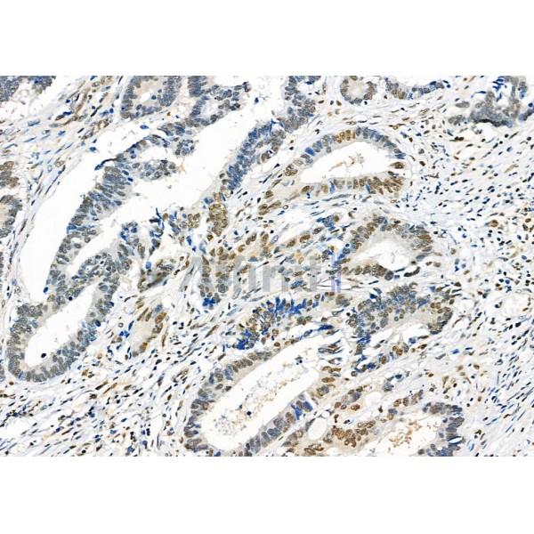 FTO Antibody - DF8421 at 1/100 staining Human colorectal cancer and adjacent normal tissues by IHC-P.