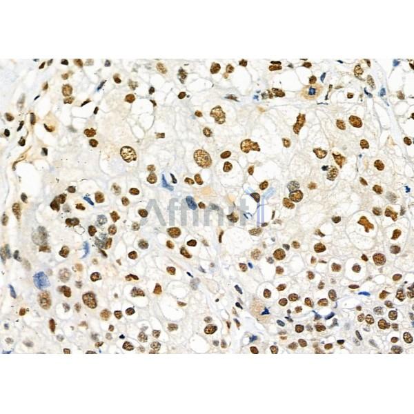 FTO Antibody - DF8421 at 1/100 staining Human ovarian cancer and adjacent normal tissues by IHC-P.