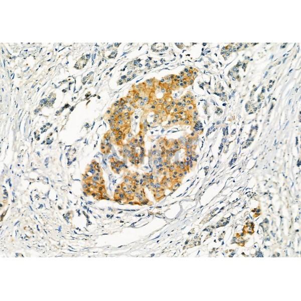 SLC30A8 Antibody - DF8719 at 1/100 staining Human pancreatic cancer by IHC-P.