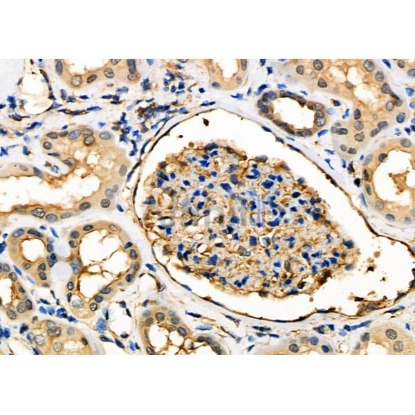GCVK_HHV7J Antibody - DF8802 at 1/100 staining Human kidney cancer and adjacent normal tissues by IHC-P.