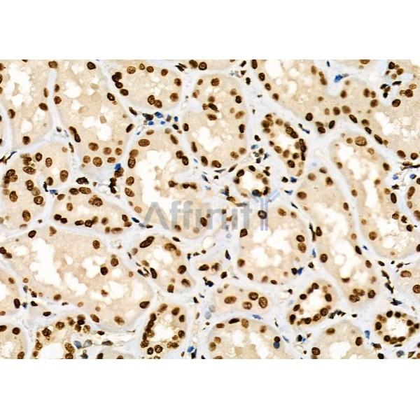 TF2A2 Antibody - DF8804 at 1/100 staining Human kidney cancer and adjacent normal tissues by IHC-P.