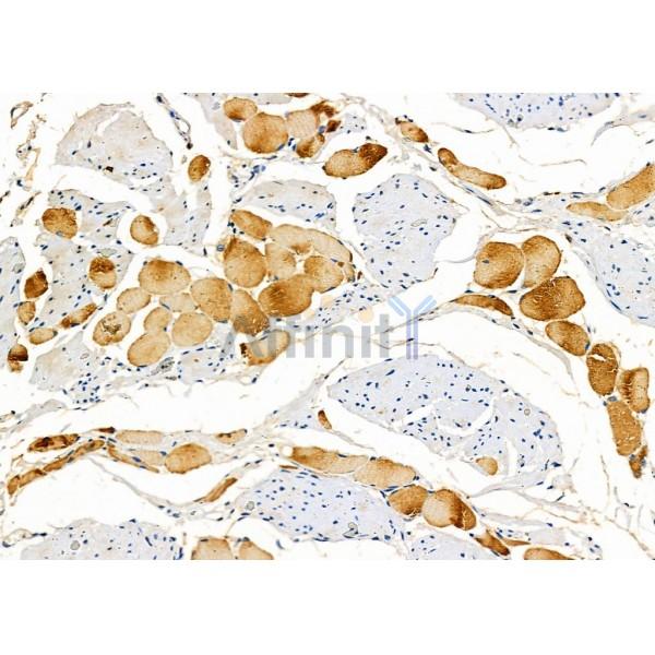 Cytochrome P450 27C1 Antibody - DF8922 at 1/100 staining Human esophageal cancer and adjacent normal tissues by IHC-P.