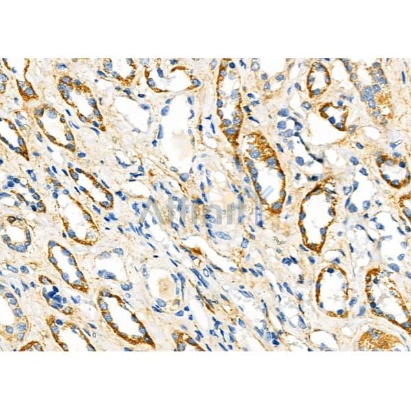FGF4 Antibody - DF8948 at 1/100 staining Human kidney cancer and adjacent normal tissues by IHC-P.