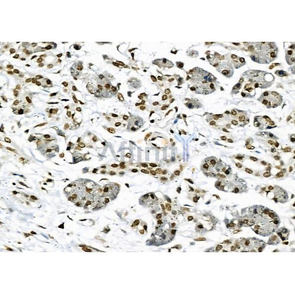 NKAP Antibody - DF9069 at 1/100 staining Human pancreatic cancer and adjacent nomal tissues by IHC-P.