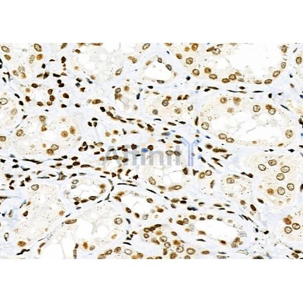 NKAP Antibody - DF9069 at 1/100 staining Human kidney cancer and adjacent normal tissues by IHC-P.