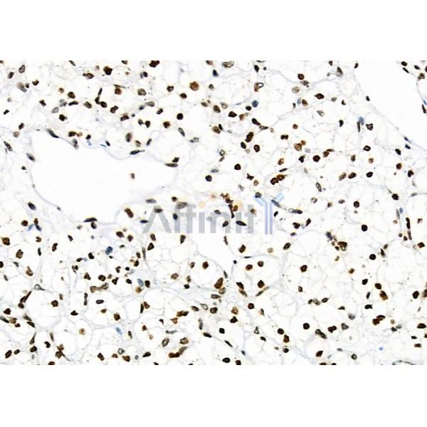 NKAP Antibody - DF9069 at 1/100 staining Human kidney cancer by IHC-P.